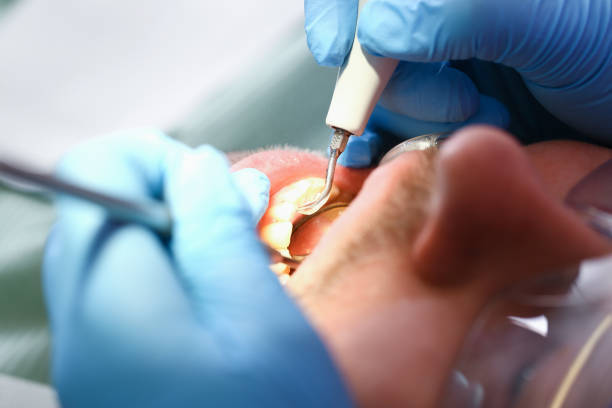 Best Emergency Dental Extractions in Centerfield, UT