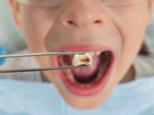 Best Emergency Dentist for Knocked-Out Tooth in Centerfield, UT
